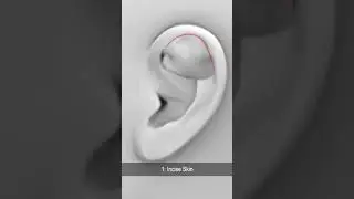 Auricular Hematoma Treatment to Prevent Cauliflower Ear #shorts @fauquierent