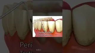 Пародонтит и лазерная хирургия: 3D-анимация