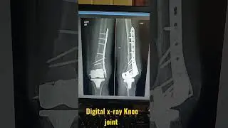digital x-ray knee joint | #kneepain #digital #xray #jointpain #operation #apex