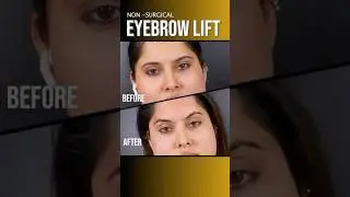 Eyebrow Lift Without Surgery | Dr  Adarsh Tripathi - Sarayu Clinics