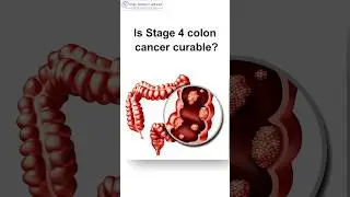 Is Stage 4 Colon Cancer Curable? #cancer