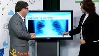 Dr. Montes de Oca || Caso clínico de cáncer de pulmón - tvsana
