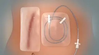 Dispositivo de bomba para el dolor