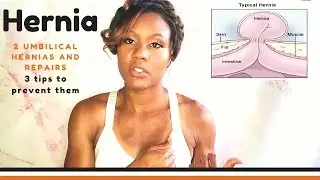 Why I had not 1 but 2 umbilical hernias and repairs with 3 tips to prevent them