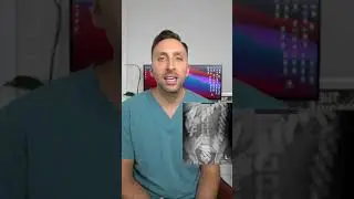 SWALLOWING DRUGS - BODY PACKING x-ray #shorts