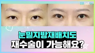 눈밑지방재배치도 재수술이 가능해요?