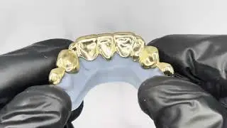 Diamond Cut Grillz Covering Broken and Missing Teeth