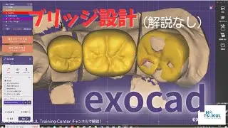 #007   exocad設計　臼歯部ブリッジ（解説なし版）