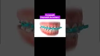 Quand les gens disent que l&rsquo;appareils dentaires ne fait pas de mal 💀 #humour #shorts #pourtoi