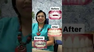 How is an Open Bite Treated? In the majority of cases, an open bite can be corrected using braces