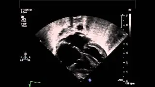 Secundum Atrial Septal Defect Subcostal Coronal 2D