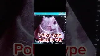 Cholecystitis | Tumefactive Sludge | Gallbladder scan #ultrasound