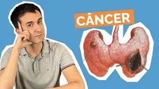 N&oacute;dulo de tireoide com microcalcifica&ccedil;&otilde;es &eacute; sempre c&acirc;ncer?