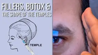 Fillers, Botox & The Shape of The Temples | Dr. Ben Talei | Beverly Hills CA
