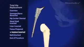 SJMO Orthopedic Joint Care Center Hip Video