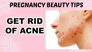 GET RID OF ACNE | PREGNANCY BEAUTY TIPS