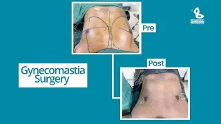Gynecomastia Surgery নিয়ে বিস্তারিত | Dr. Iqbal Ahmed | Doctor Talk | Bangladesh Cosmetic Surgery