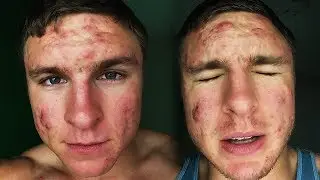 Having Confidence With Acne Is Hard...
