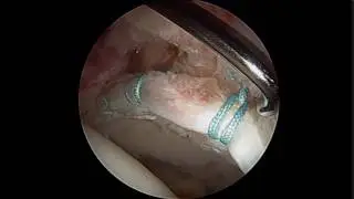 Labrum repaired - Cody Harlan MD