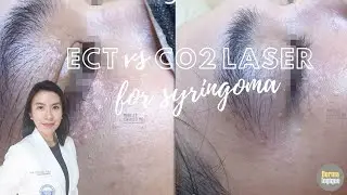 Syringoma Removal: Electrocautery vs CO2 Laser