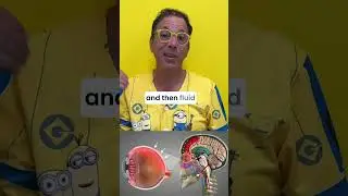 Double whammy of blurry vision and fatigue #cervicalinstability #vision #braindrain #pressure