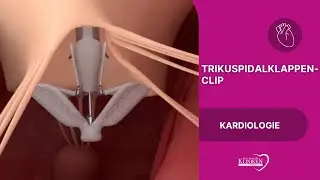 Trikuspidalklappen Clip - Minimalinvasive Behandlung der Trikuspidalinsuffizienz