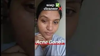 Pimple & Acne Soap| Mudaura Multani Mitti Soap #shorts #youtubeshortsvideo
