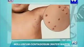 UNTV Life: What causes water warts  in adults and kids?