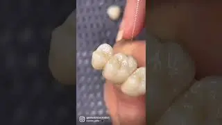 Staining zirconia bridge with miyo