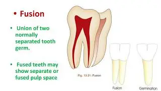 Teeth of different Anatomy : Gemination, Fusion, Concrescence, Taurodontism, Talons cusp & more