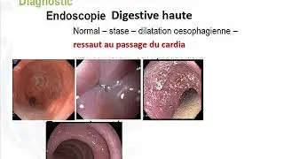 Achalasie CAPSULE UM6SS Digital