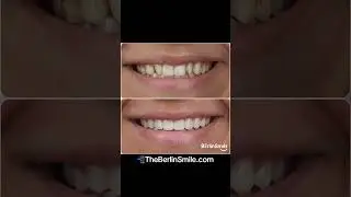 Two prepless veneers. Small change. Big difference. 😌 #shorts #texas #veneers