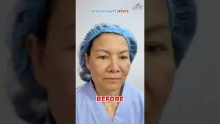 55 Years Old Facelift #shorts