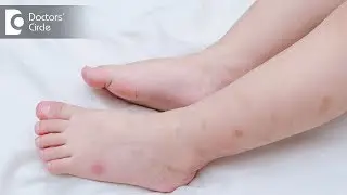 How to identify and manage bug bite marks? - Dr. Aruna Prasad
