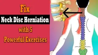 How Disc Herniation Happens & 5 Simple Exercises to Fix It!