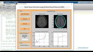 Brain Tumor Detection and Classification using Artificial Neural Network MATLAB code