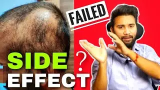 Must Watch Before Going For Hair Transplant || Shock Loss After Hair Transplant