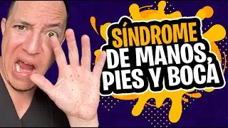 Todo sobre el S&iacute;ndrome de pies, manos y boca