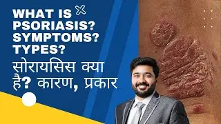 What is Psoriasis? Types & Symptoms of Psoriasis? सोरायसिस क्या है? कारण, प्रकार