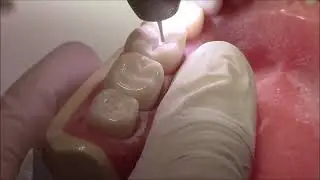 Tutorial on Class I Cavity Preparation Amalgam Restoration   MyDentCart