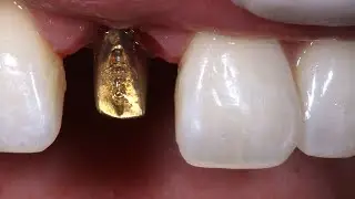 How to Get the Best Aesthetic For A Single Implant Crown