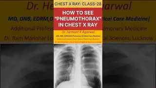 CXR-28: PNEUMOTHORAX- How to identify in Chest X Ray PA View @dr.hemantkumaragarwal-pccm7789