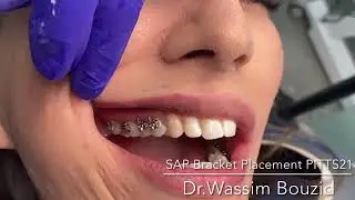 Cementaci&oacute;n de brackets Pitts21, OC Orthodontics | Gexa Chile