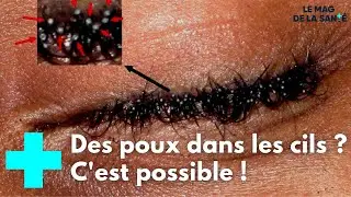 Eyelash lice: where do they come from and how to get rid of them? - Health Magazine