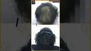 Finasteride results | Finasteride before and after | Finasteride #youtubeshorts  #finasteride