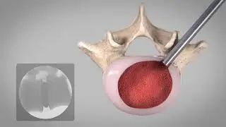 Spineology: OptiLIF with the OptiMesh Expandable Interbody Fusion System
