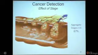 Screening for Colon Cancer - by Richard M. Goldberg, MD