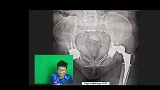 Causes hip dislocation post total hip replacement