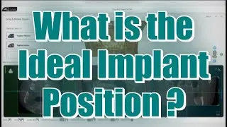 Implant Planning Basics  (Atomica AI) - 5. Guidelines for Ideal Implant Planning