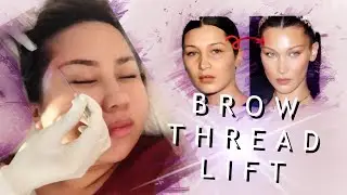 Getting my Foxy Eyes : Brow Thread Lifts aka Non-Surgical Brow Lifts